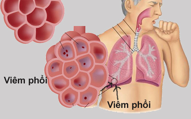 Đừng bỏ qua 8 dấu hiệu bệnh viêm phổi trong mùa lạnh